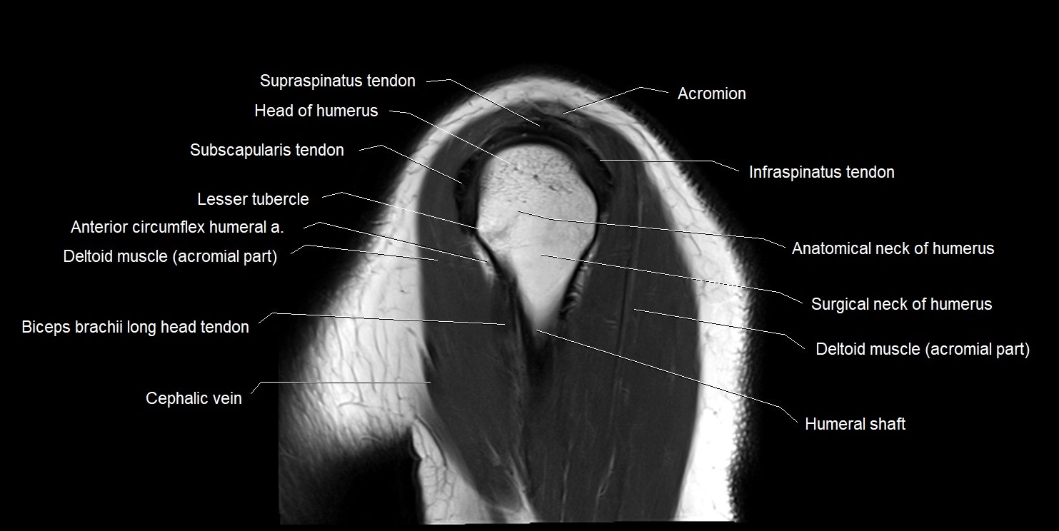 mri shoulder sagittal cross sectional anatomy image 15.webp